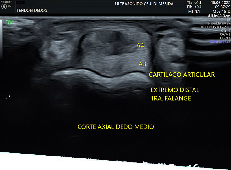 Ultrasonido musculoesquelético en Villahermosa - Ultrasonido Musculoesquelético en Villahermosa