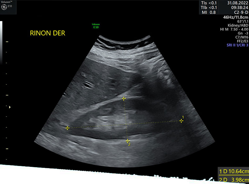 ¿Cómo saber si una persona tiene insuficiencia renal?