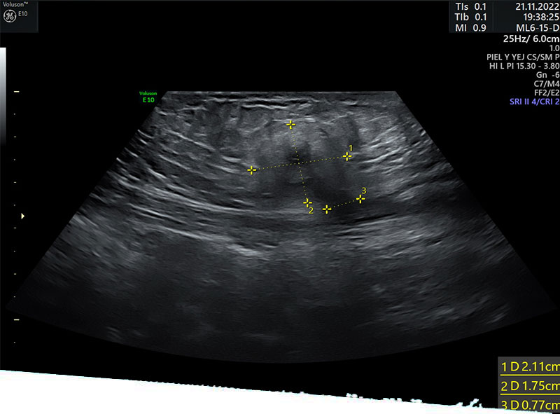 Ultrasonido de partes blandas en Villahermosa