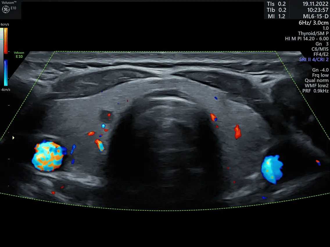 Ultrasonido de Tiroides