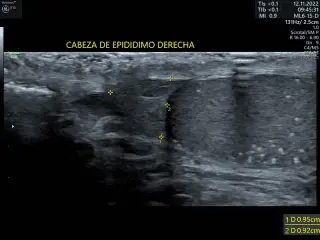 CABEZA-DE-EPIDIDIMO-320x240-1