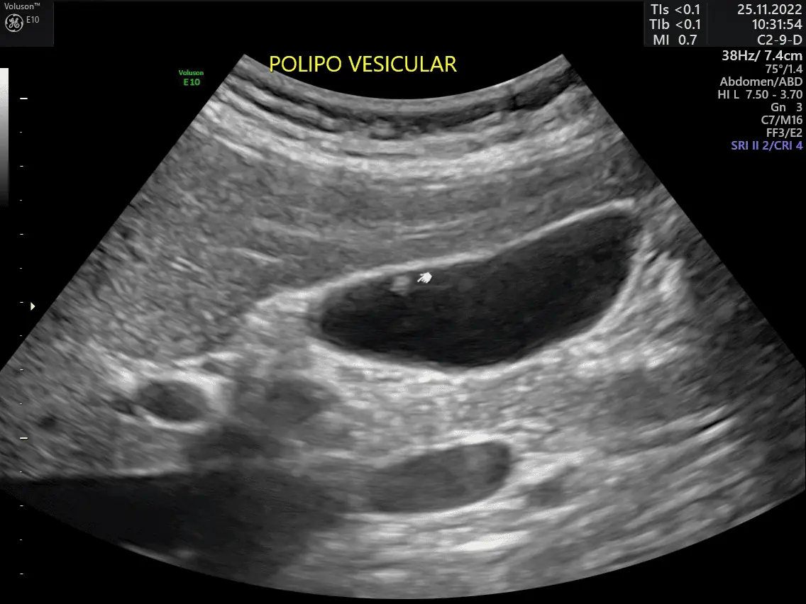 POLIPO-VESICULAR