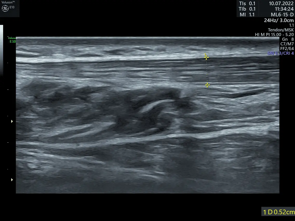 RODILLA-1