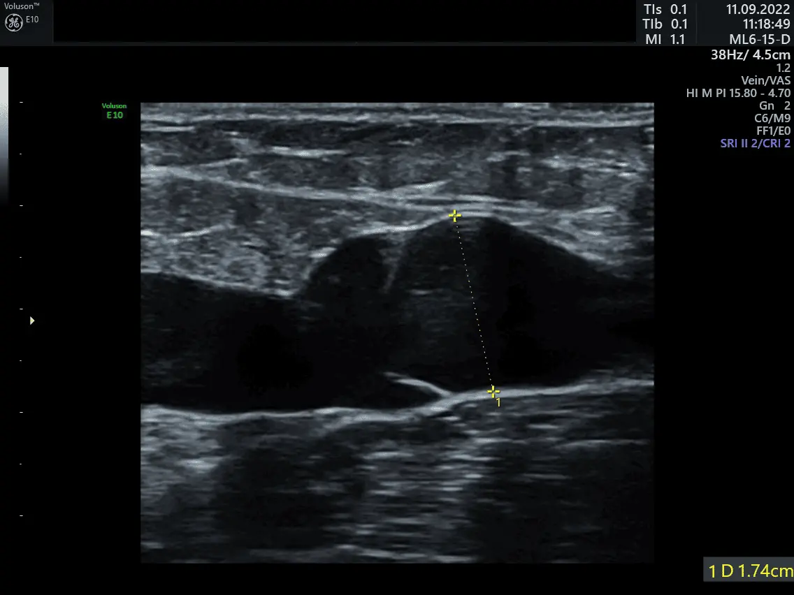 VASCULAR-2